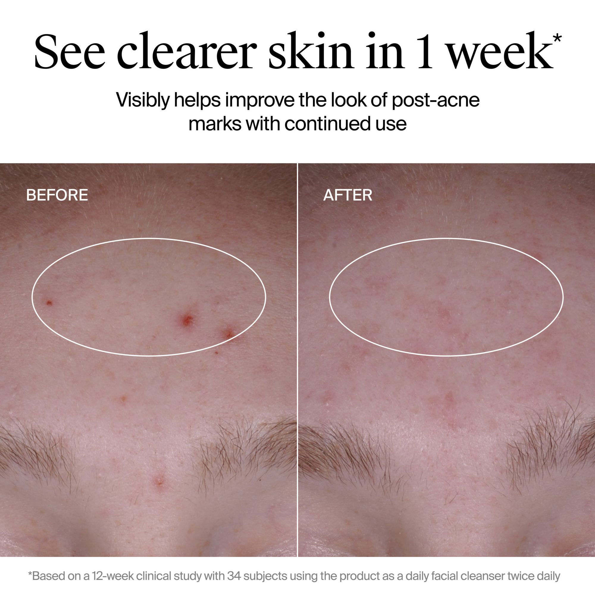 Neutrogena Evenly Clear Acne Cleanser 9.1 fl. oz./ 2 pk.